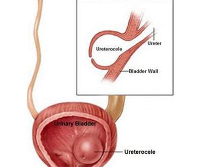 Ureterocele Pictures, Symptoms, Causes, Diagnosis, Treatment, Ultrasound