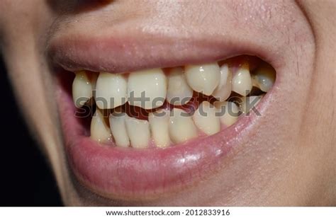 709 Impacted Tooth Stock Photos, Images & Photography | Shutterstock