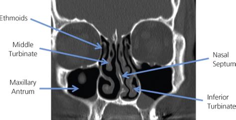 Paranasal Sinus Disease | Ento Key