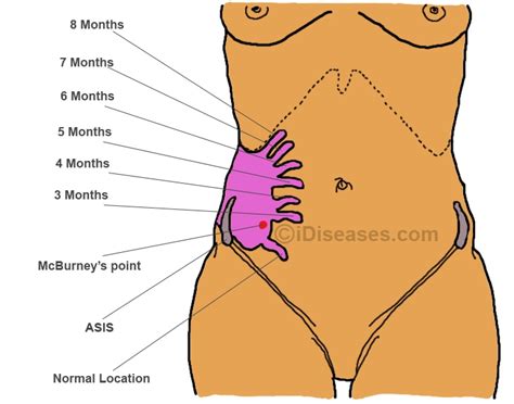 Appendix Pain - Location, Symptoms, Causes and Treatment