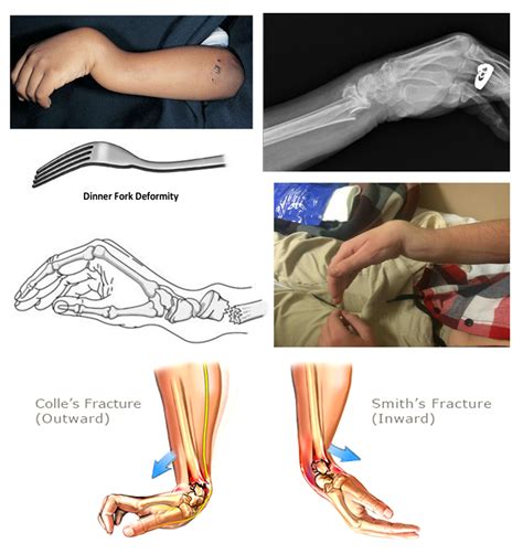 This! 46+ Little Known Truths on Median Nerve Injury Deformity ...