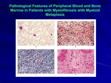 Myeloproliferative disorders.ppt