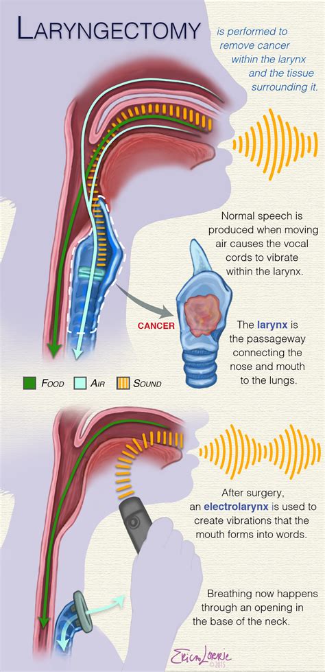 Patient Education: Laryngectomy – Erica Lorrie