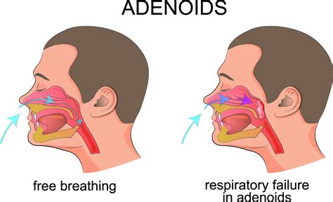 Adenoidectomy