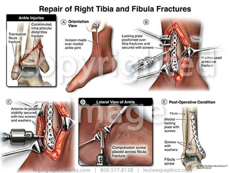 Ankle Surgery - Legal Graphicworks