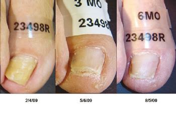 Before/After - Laser Nail Therapy