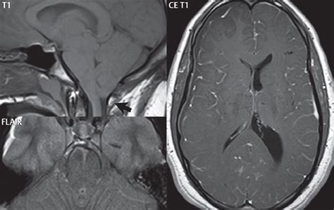 Herniation | Radiology Key