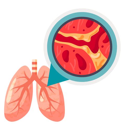 Bronchiectasis Complications: What’s at Risk? | SmartVest