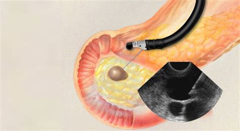 Accurate Endoscopic Ultrasound in Mumbai | Expert Gastroenterologists