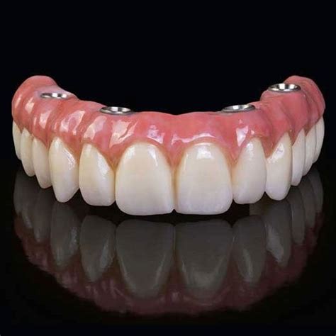 Improve Your Smile With Hybrid Dentures At Partha Dental