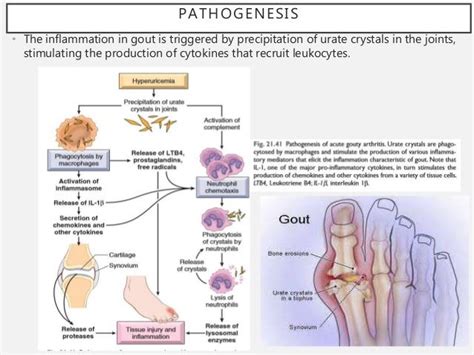 Pathophysiology of Gout