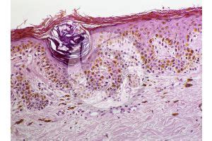 Man. Lentigo simplex. Lentigo. Vertical section. 125X - Nevus - Mammals - Integumentary system ...