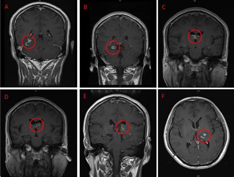 Parasite In Brain