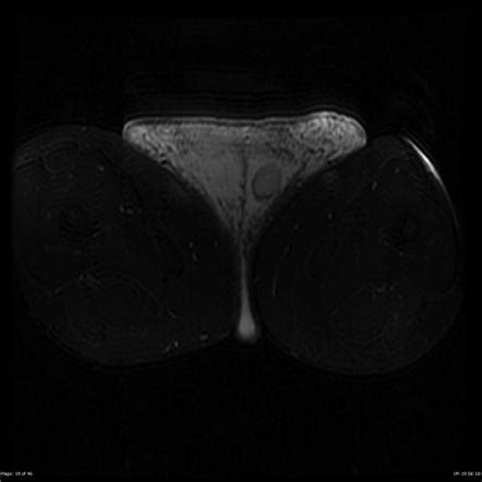 Scrotal lymphedema | Radiology Case | Radiopaedia.org