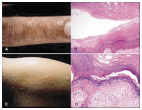 Peeling skin syndrome: 11 cases from Saudi Arabia | Annals of Saudi Medicine