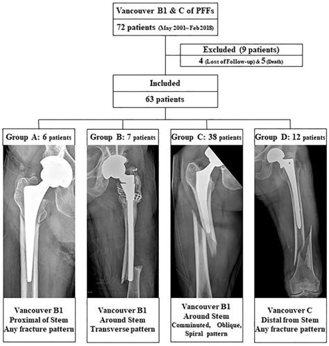 Femur Fracture Anatomy