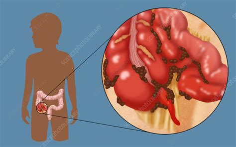 Ruptured Appendix - Stock Image - C022/1266 - Science Photo Library