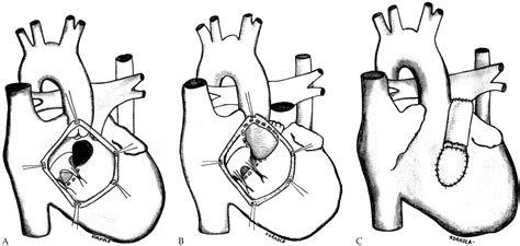 Single-stage anatomical repair of complete atrioventricular canal ...