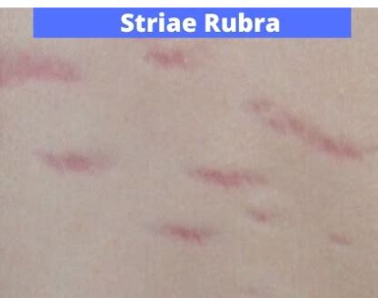 Types of Stretch Marks/ Striae - Phade