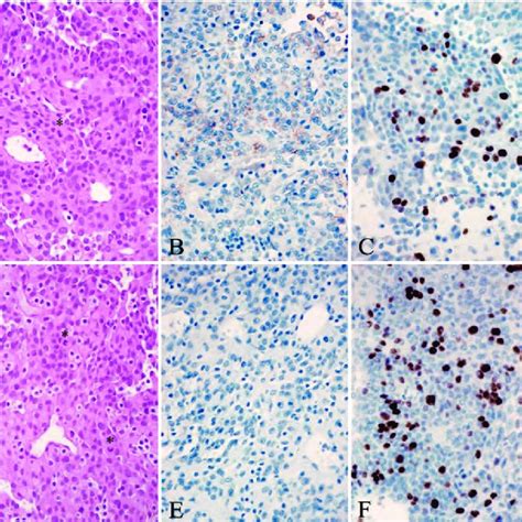 Histological features of the primary and secondary tumors. A: The ...