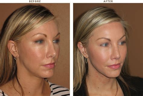 Mid Face Lift – Before and After Pictures * | Dr Turowski - Plastic ...