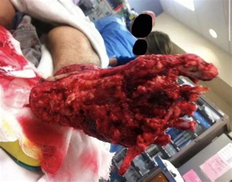 degloving injury from motorcycle accident : r/MedicalGore