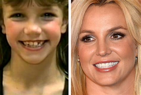 Britney Spears Before and After Cosmetic Surgery - Verge Campus