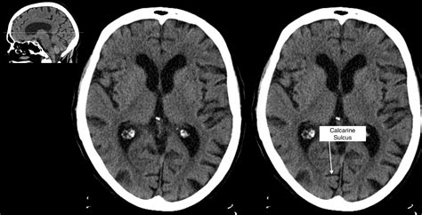 Radiological Anatomy: Calcarine Sulcus - Stepwards