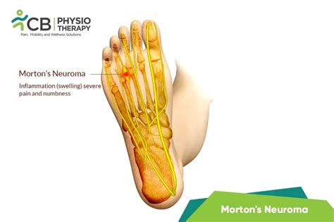 top-5-exercises-for-morton-s-neuroma.webp