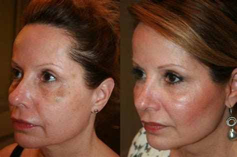 Patient Story:: 50 year old female patient Ultherapy/ Thread - John ...