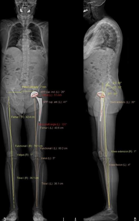 EOS Scan Spine & Body Imaging - Panorama Radiology Specialists