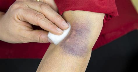 Bruise: Types, Symptoms, Causes, Prevention & Treatment