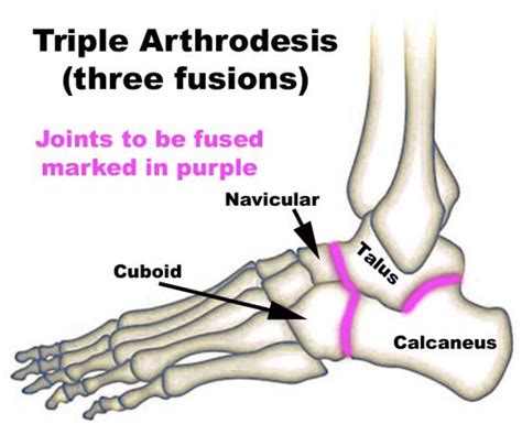 Triple Arthrodesis - Drwolgin