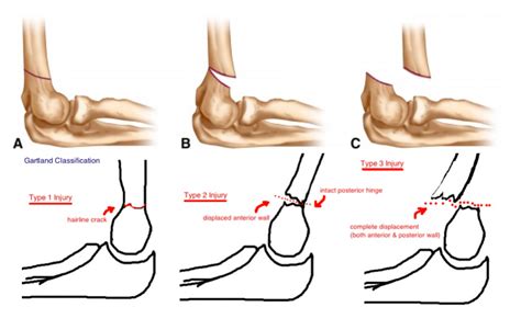 Supracondylar Fracture Median Nerve