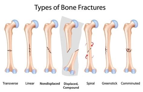 Fractures Nursing Care Plan & Management - RNpedia