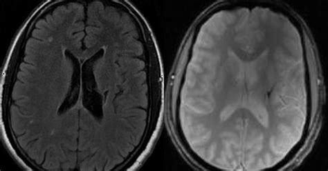 Neuroradiology Cases: Wallerian degeneration MRI Brain