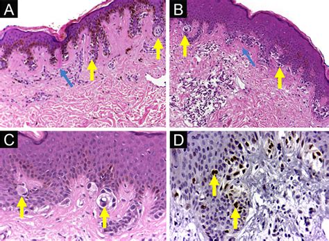 Dysplastic nevus syndrome: (A) Classical Dysplastic Nevus (CDN):... | Download Scientific Diagram