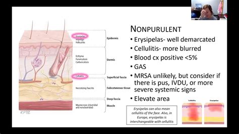 Skin Soft Tissue Infection - YouTube