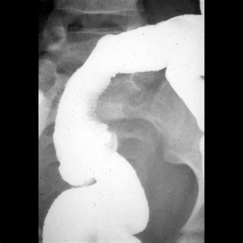 Teenager with abdominal pain | Pediatric Radiology Case | Pediatric Imaging | @pedsimaging ...