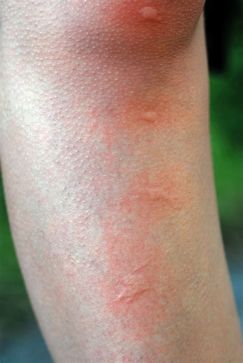 Hives Treatment Manassas, Mclean, Washington DC | Kletz