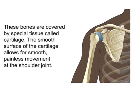 PatEdu.com : Shoulder Replacement - Preventing Post-Op Complications