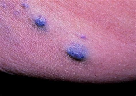 Blue Rubber Bleb Nevus Syndrome: Causes, Symptoms, Diagnosis, Treatment ...