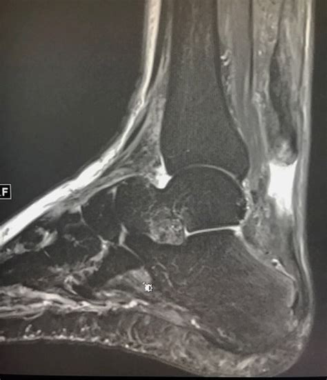 Achilles Tendon Mri Images