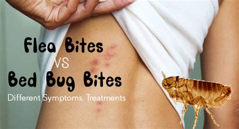 Flea Bites vs. Bed Bug Bites: Different Symptoms, Treatments - Allergy-symptoms.org