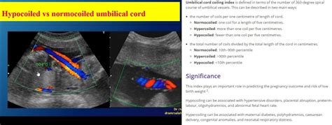 Hyocoiled vs Normocoiled umbilical cord | Cord