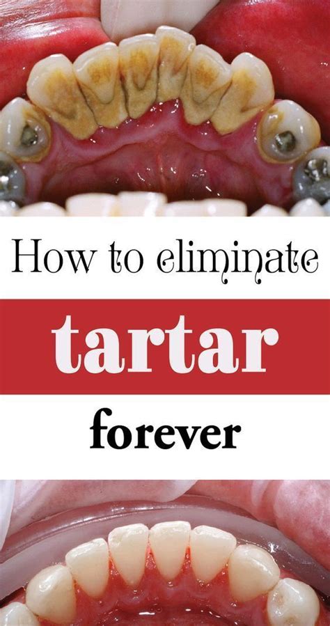 10 EFFECTIVE TRICKS TO REMOVE PLAQUE AND TARTAR – BE YOUR OWN DENTIST ...