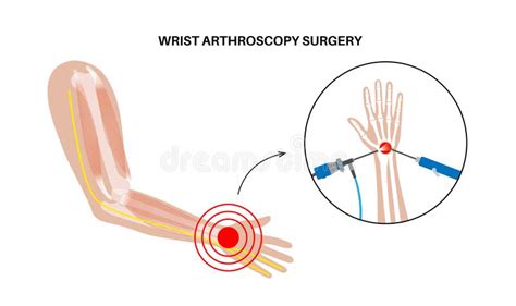 Wrist arthroscopy surgery stock illustration. Illustration of treatment - 332620611