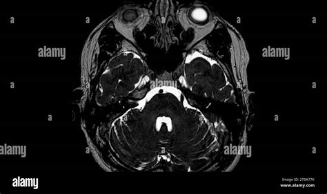 MRI scan of the internal auditory canal (IAC Stock Photo - Alamy