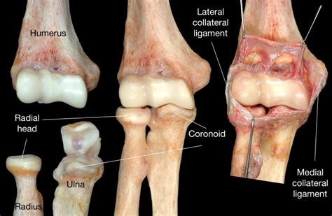 Why Is It That Surgeons Call Certain Elbow Injuries “Terrible Triad”? - Shoulder & Elbow