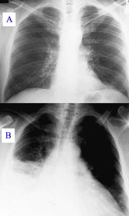 Pulmonary consolidation - wikidoc